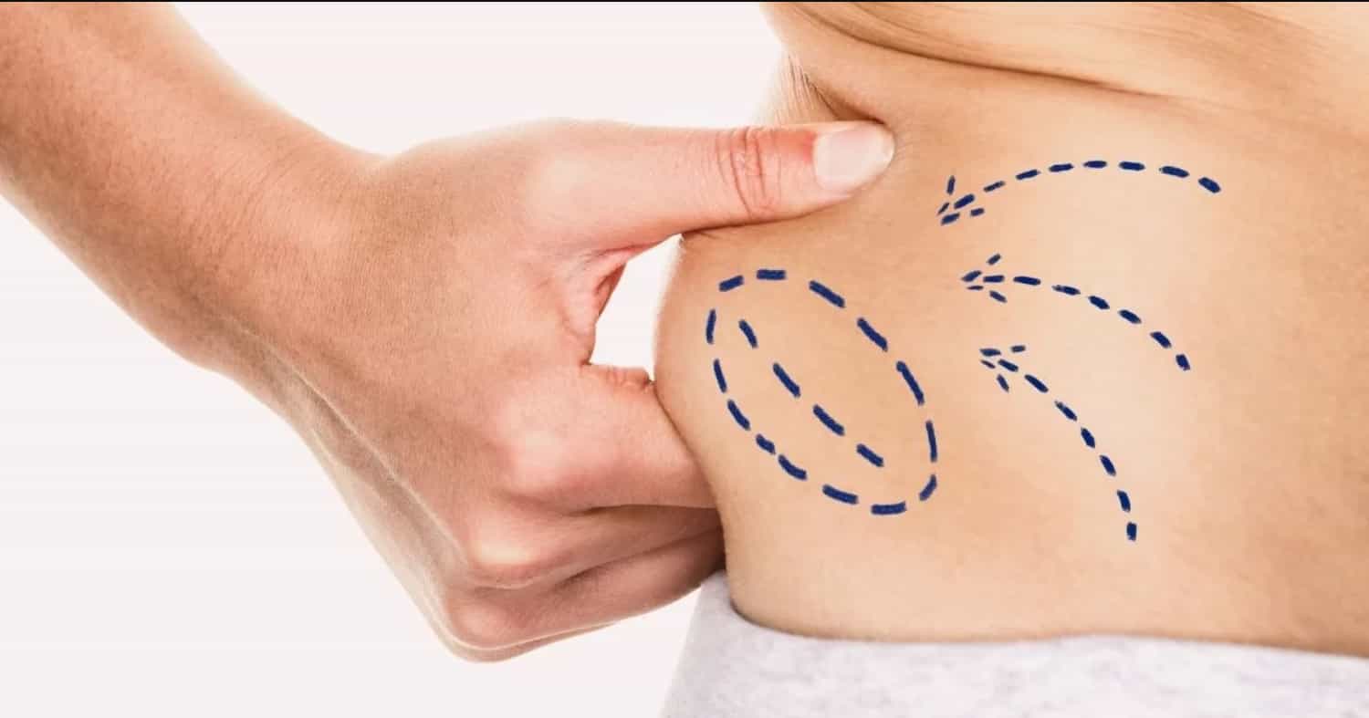 Healthy Living Post-Liposuction Insights from Best Doctors in Dubai